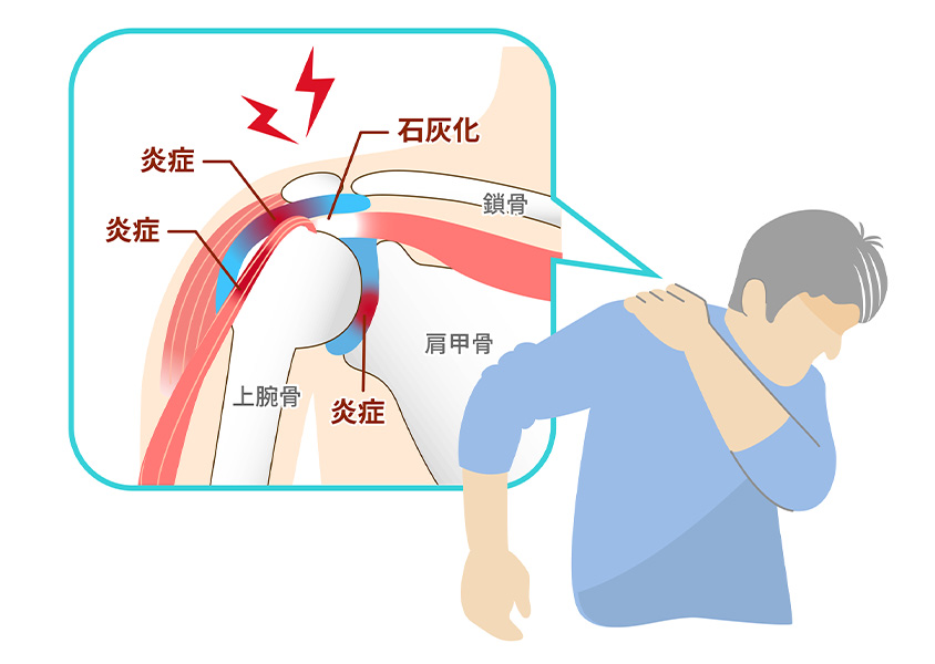 五十肩