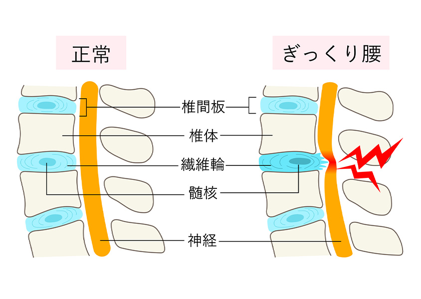 ぎっくり腰