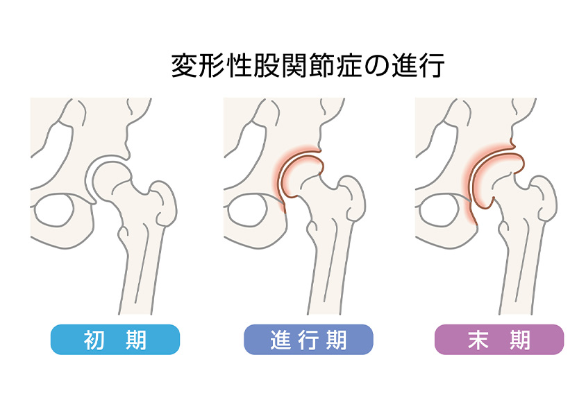 股関節痛