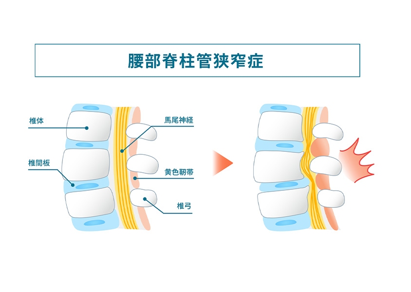 脊柱管狭窄症