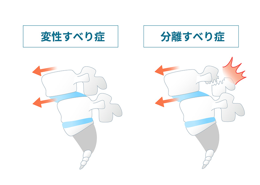 すべり症